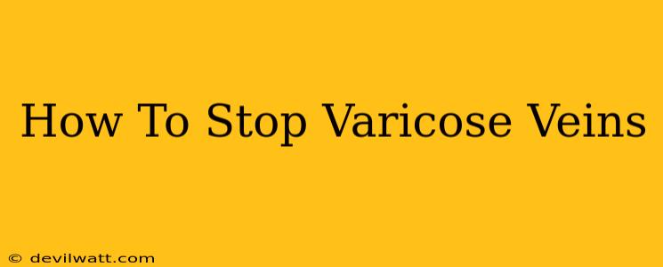 How To Stop Varicose Veins